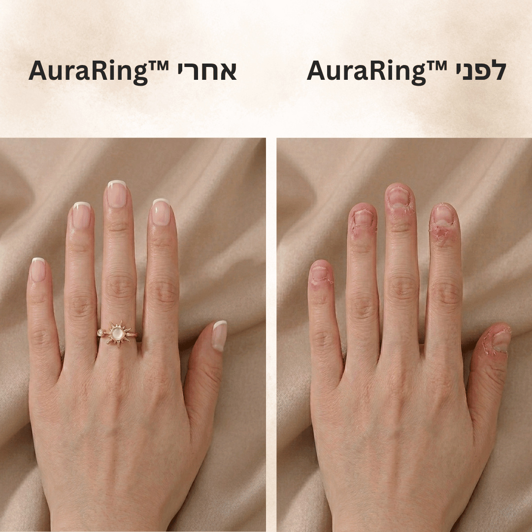 ™AuraRing - טבעת קרני אור להפסקת כסיסת ציפורניים והפחתת מתח